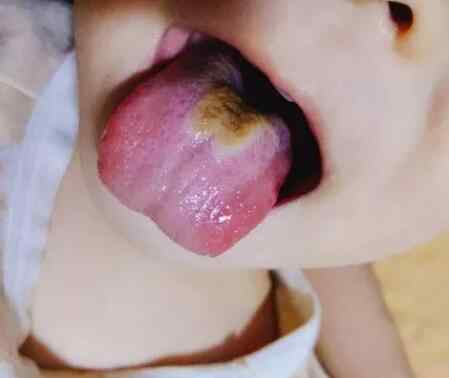 孩子积食久了，会有一些什么样的后果？