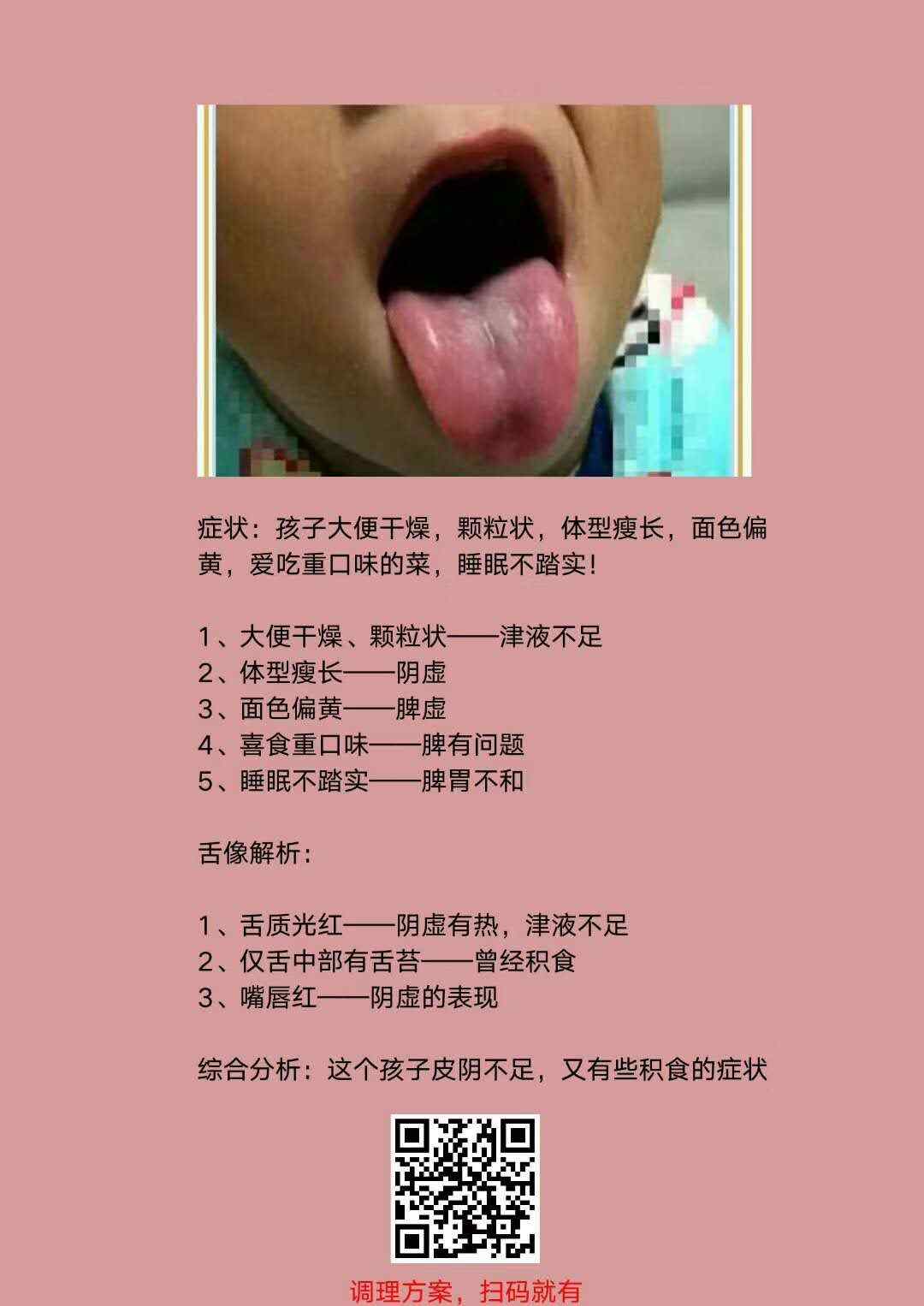 生活中常见儿童舌苔分析诊断——阴虚积食