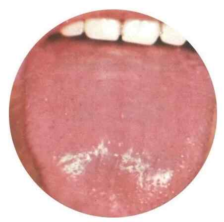 脾胃阳虚舌像.jpg 脾胃阳虚舌像.jpg