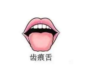 齿痕舌是湿气重还是脾胃虚弱.jpg