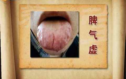 脾虚气虚便秘怎么调理 脾虚气虚便秘.jpg 脾虚气虚便秘怎么调理 脾虚气虚便秘.jpg