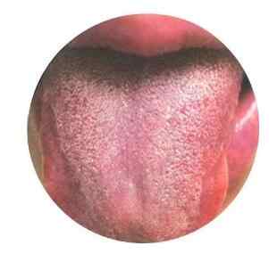 湿热典型舌苔.jpg 湿热典型舌苔.jpg