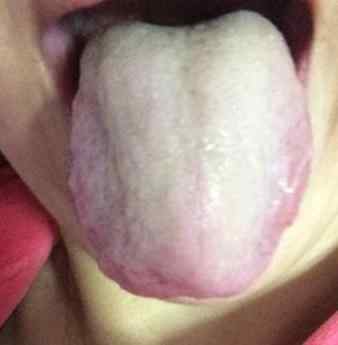 舌苔厚白口臭.jpg