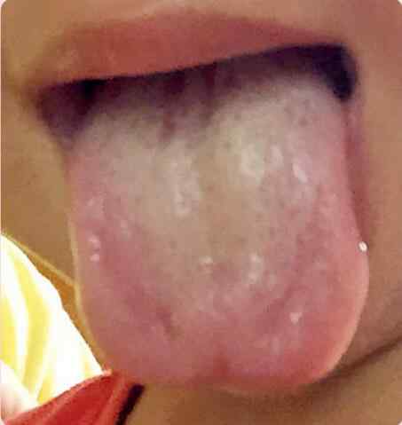 孩子舌苔厚发黄怎么回事.jpg 孩子舌苔厚发黄怎么回事.jpg