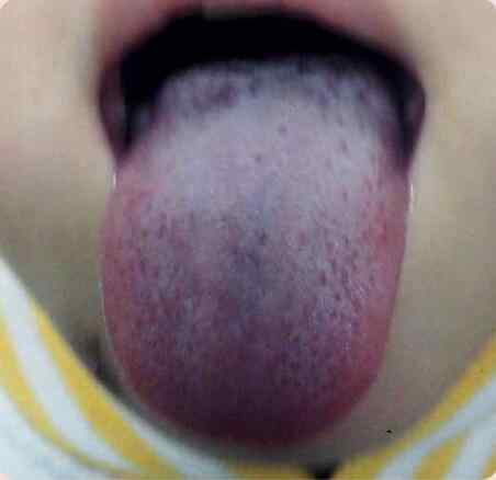 孩子口臭肚子胀舌像.jpg 孩子口臭肚子胀舌像.jpg