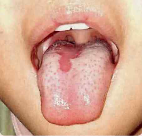 舌苔剥落是怎么回事？舌苔剥落怎么调理呢？