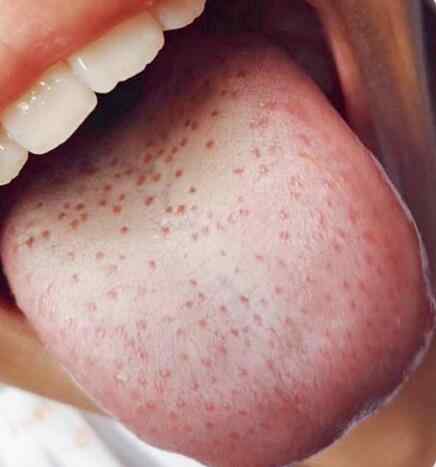 痰湿重的孩子,舌苔很厚,舌上有小红点.jpg 痰湿重的孩子,舌苔很厚,舌上有小红点.jpg