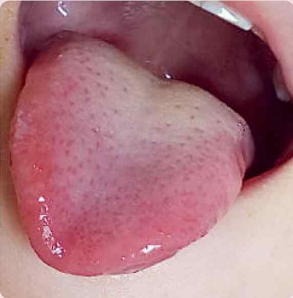 孩子舌尖红、舌苔厚、咳嗽不停是怎么回事？