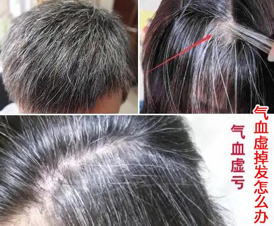 气血虚掉发怎么办,就用它大补气血