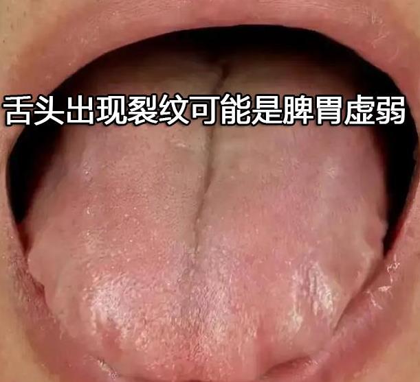 舌头出现裂纹可能是脾胃虚弱.jpg