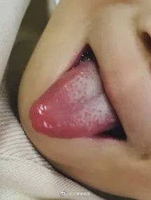 积食有哪些表现？