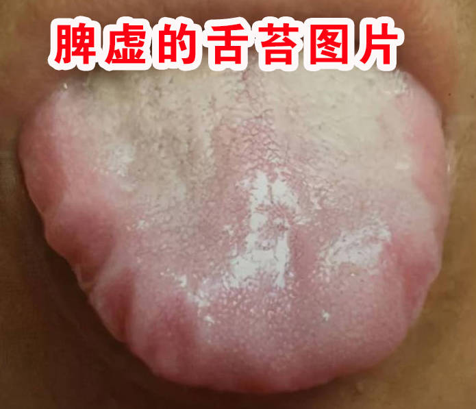脾虚的舌苔图片、看看你是这样吗？