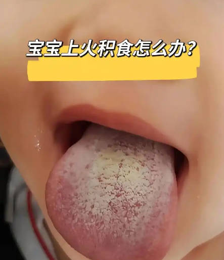 宝宝积食上火要怎么办 认识积食巧化解.jpg