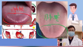 肺寒和肺热的区别有哪些 既有不同因又有不果