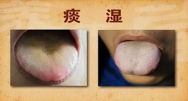 脾胃虚弱痰湿重吃什么药最好