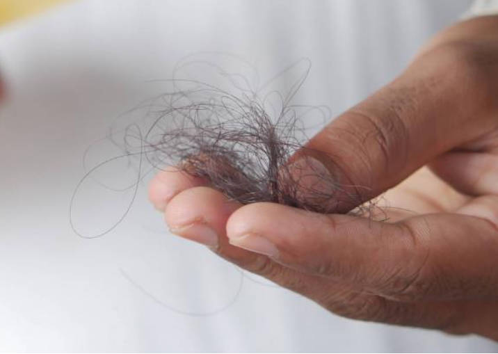 “转阴”后脱发，到底怎么回事？