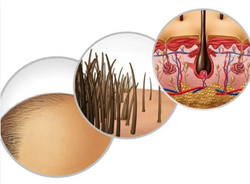 男性脱发，是毛囊不断在退化