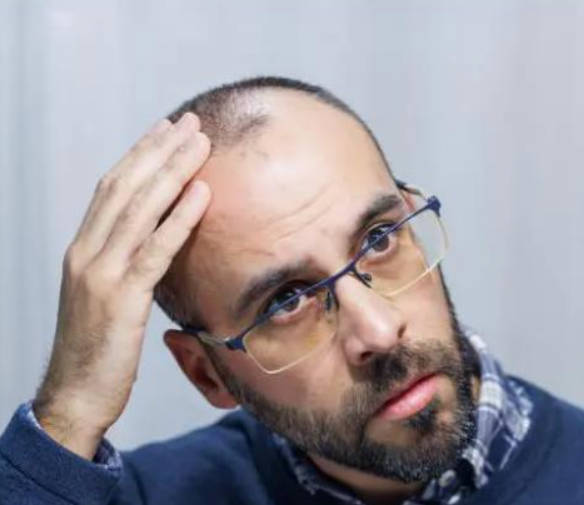 脱发除了植发还有其他改善方法吗？