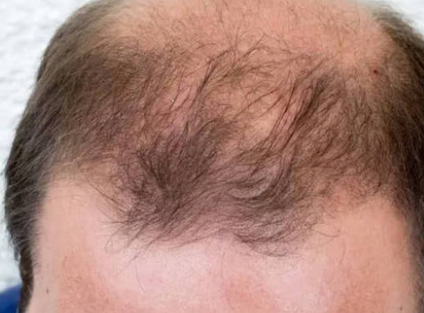 男性毛发与肾功能有密切关系