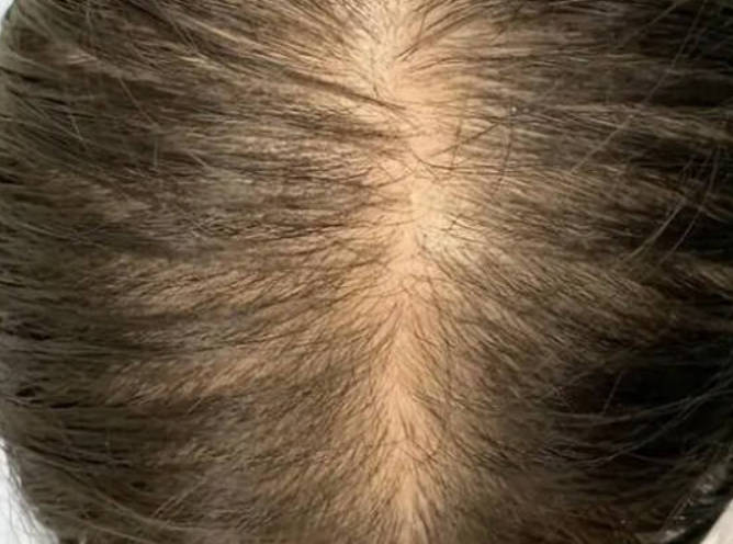 如何防止脱发？