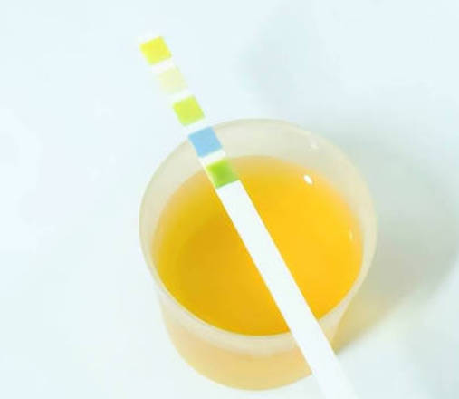 除了肾虚，引起尿黄的原因有哪些？