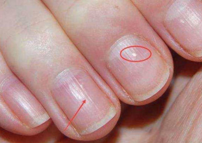 看指甲颜色、辨健康状态