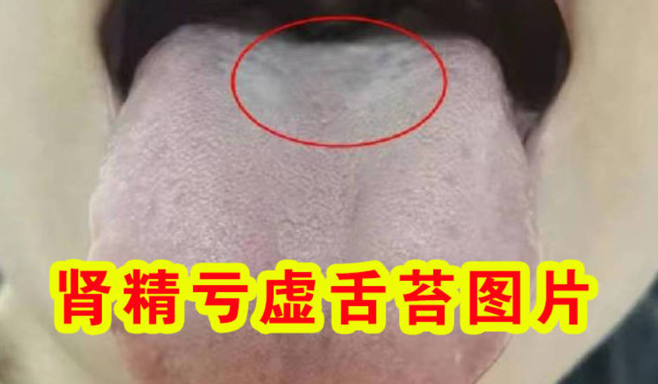 肾精亏虚舌苔图片、看看你是这样吗