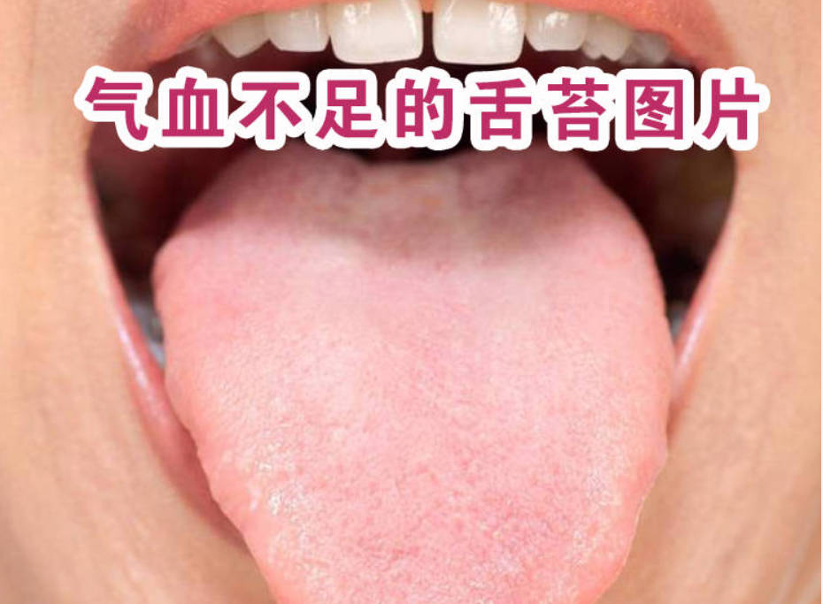 气血不足的舌苔图片、看看你是气血亏虚吗？